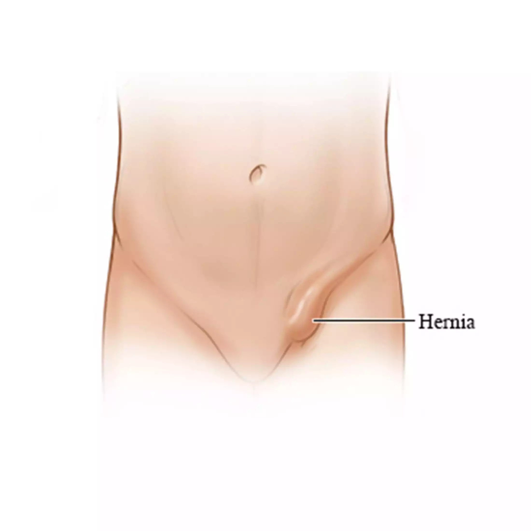 Hernia Inguinalis